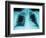 X-Ray of Dark Lungs-Robert Llewellyn-Framed Photographic Print