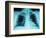 X-Ray of Dark Lungs-Robert Llewellyn-Framed Photographic Print