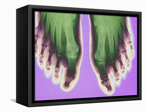 X-ray of Feet-null-Framed Premier Image Canvas