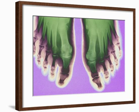 X-ray of Feet-null-Framed Premium Photographic Print