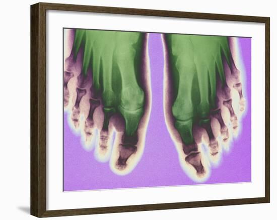 X-ray of Feet-null-Framed Photographic Print