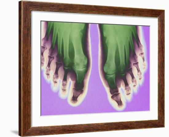 X-ray of Feet-null-Framed Photographic Print