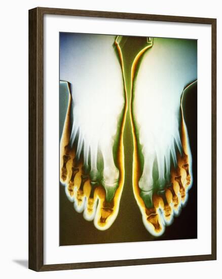 X-ray of Feet-null-Framed Photographic Print