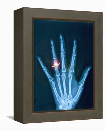 X-ray of hand with diamond ring-Thom Lang-Framed Premier Image Canvas