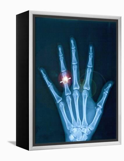 X-ray of hand with diamond ring-Thom Lang-Framed Premier Image Canvas