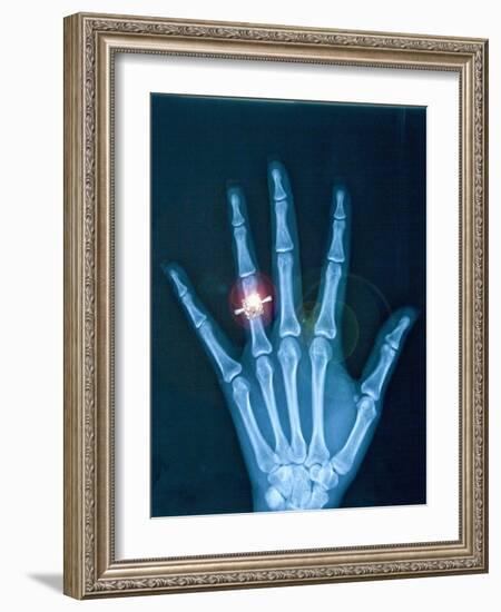 X-ray of hand with diamond ring-Thom Lang-Framed Photographic Print