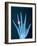 X-ray of hand with diamond ring-Thom Lang-Framed Photographic Print