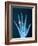 X-ray of hand with diamond ring-Thom Lang-Framed Photographic Print