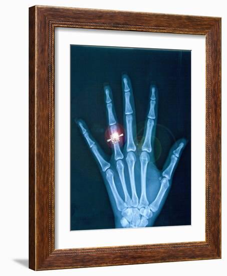 X-ray of hand with diamond ring-Thom Lang-Framed Photographic Print