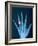 X-ray of hand with diamond ring-Thom Lang-Framed Photographic Print