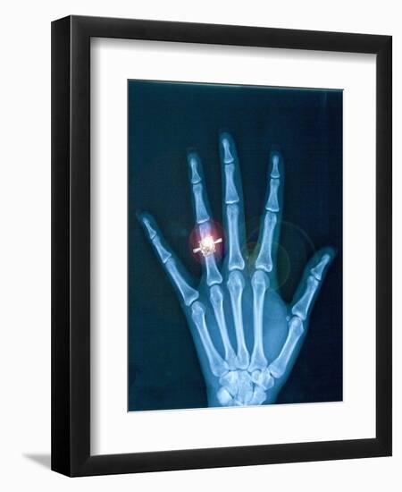 X-ray of hand with diamond ring-Thom Lang-Framed Photographic Print