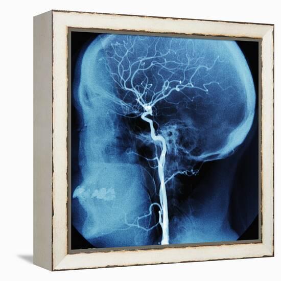 X-Ray of Human Head-Robert Llewellyn-Framed Premier Image Canvas