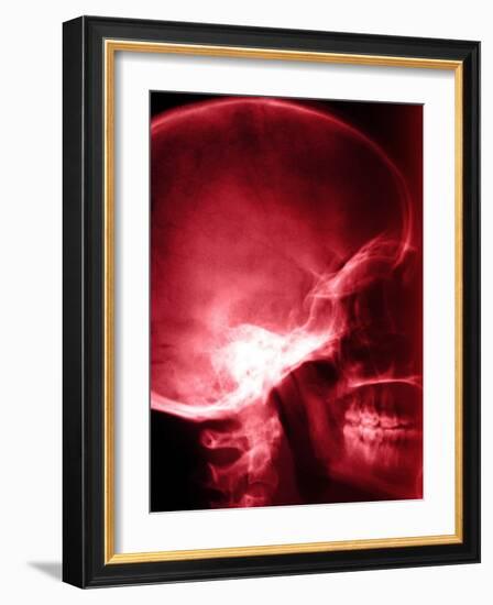 X-Ray of Human Skull-null-Framed Photographic Print