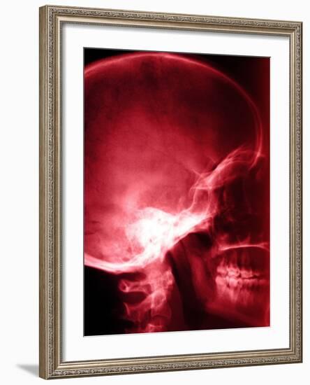 X-Ray of Human Skull-null-Framed Photographic Print