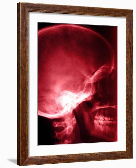 X-Ray of Human Skull-null-Framed Photographic Print