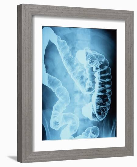 X-Ray of Intestines-Robert Llewellyn-Framed Photographic Print