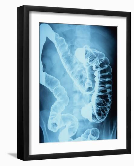 X-Ray of Intestines-Robert Llewellyn-Framed Photographic Print