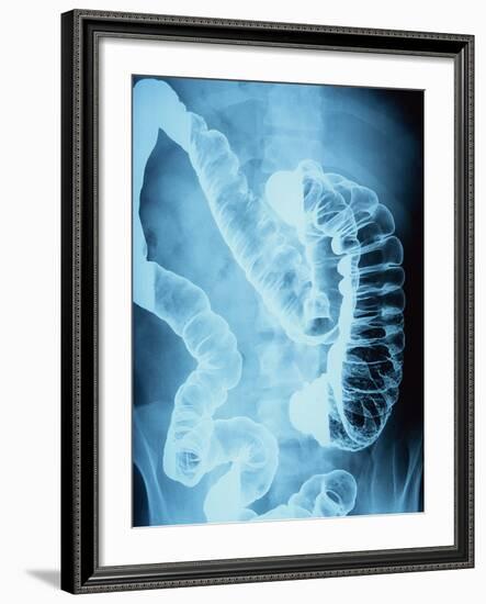 X-Ray of Intestines-Robert Llewellyn-Framed Photographic Print