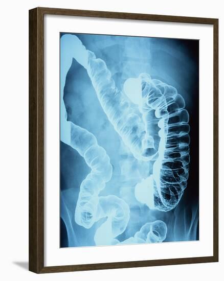 X-Ray of Intestines-Robert Llewellyn-Framed Photographic Print