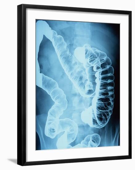 X-Ray of Intestines-Robert Llewellyn-Framed Photographic Print