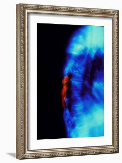 X-ray of Osteoporosis of the Thoracic Spine-Science Photo Library-Framed Photographic Print