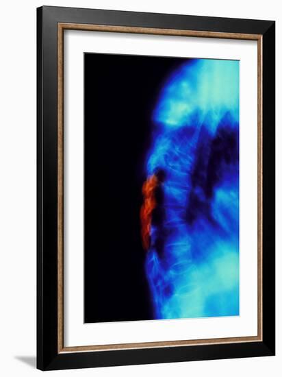 X-ray of Osteoporosis of the Thoracic Spine-Science Photo Library-Framed Photographic Print