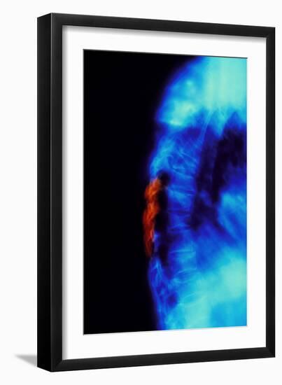 X-ray of Osteoporosis of the Thoracic Spine-Science Photo Library-Framed Photographic Print