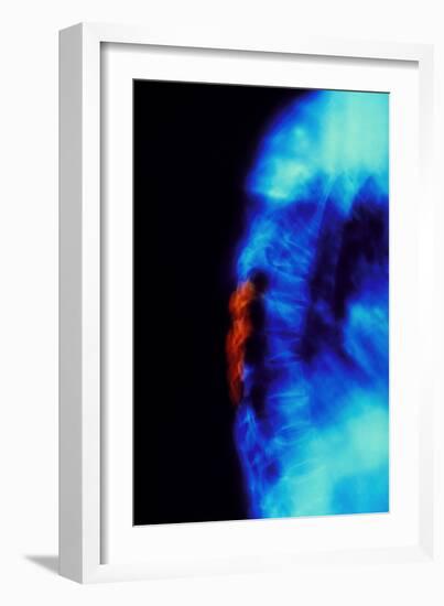 X-ray of Osteoporosis of the Thoracic Spine-Science Photo Library-Framed Photographic Print