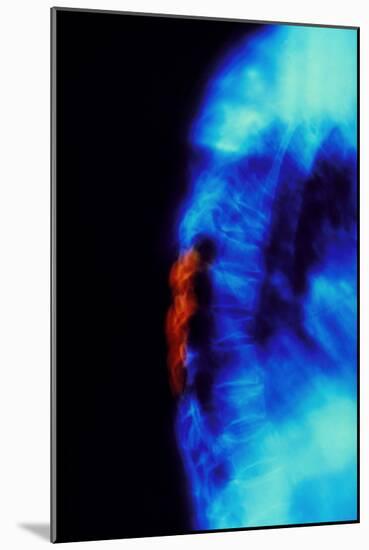 X-ray of Osteoporosis of the Thoracic Spine-Science Photo Library-Mounted Photographic Print