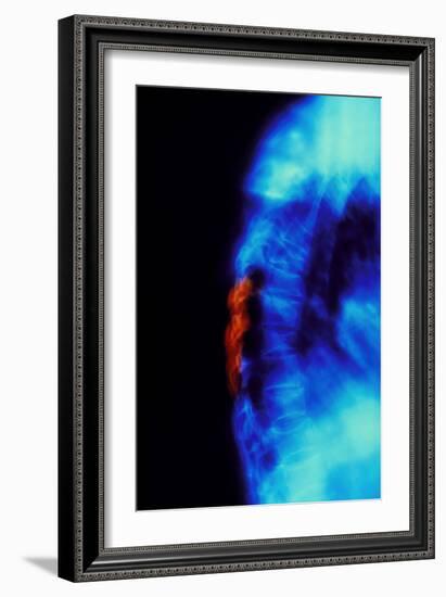 X-ray of Osteoporosis of the Thoracic Spine-Science Photo Library-Framed Photographic Print