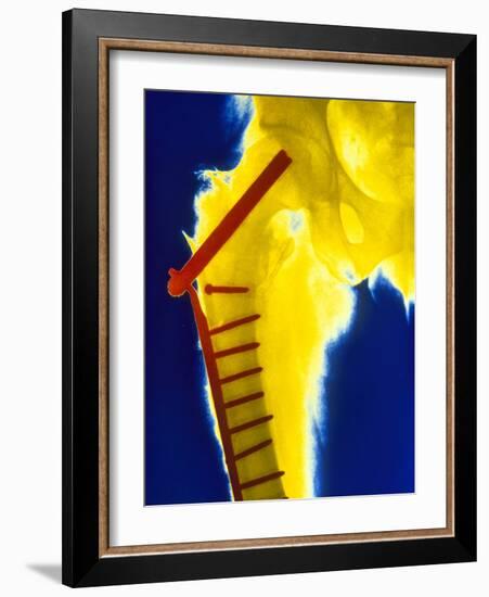 X-ray of the Broken Head of the Femur-Science Photo Library-Framed Photographic Print