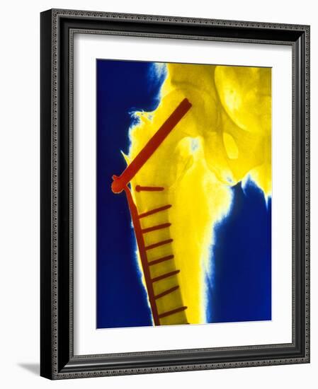 X-ray of the Broken Head of the Femur-Science Photo Library-Framed Photographic Print