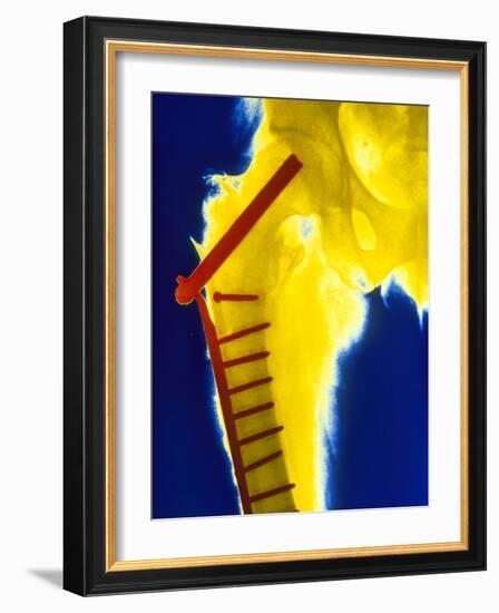 X-ray of the Broken Head of the Femur-Science Photo Library-Framed Photographic Print