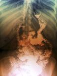 Gastric Bypass Surgery, X-ray-ZEPHYR-Photographic Print