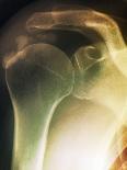 Tendinitis of the Shoulder, X-ray-ZEPHYR-Photographic Print